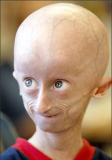 progeria child.jpg